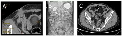 Late-Onset Ileocutaneous Fistula Eight Years After Plug Repair With Polypropylene Mesh: A Case Report